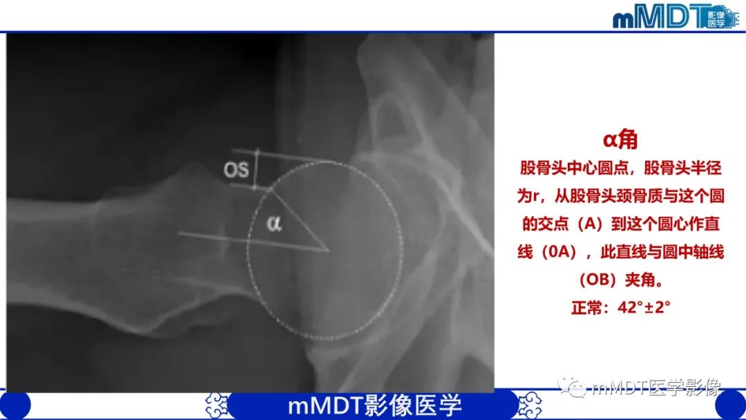 影像PPT - 【PPT】髋关节疼痛临床与影像(一)-14 影像PPT - 【PPT】髋关节疼痛临床与影像(一)-14