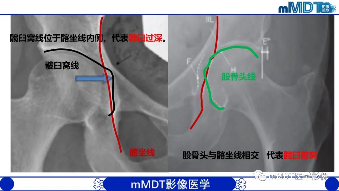 影像PPT - 【PPT】髋关节疼痛临床与影像(一)-21 影像PPT - 【PPT】髋关节疼痛临床与影像(一)-21