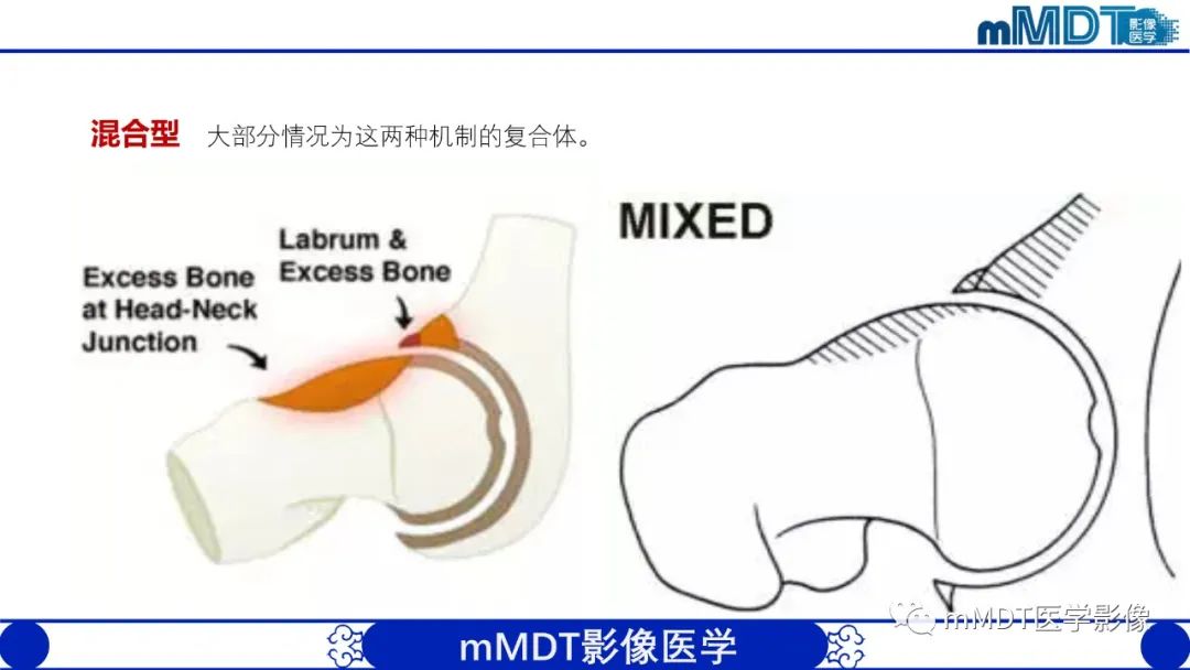 影像PPT - 【PPT】髋关节疼痛临床与影像(一)-26 影像PPT - 【PPT】髋关节疼痛临床与影像(一)-26
