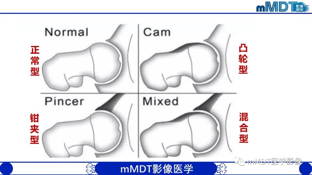 影像PPT - 【PPT】髋关节疼痛临床与影像(一)-16 影像PPT - 【PPT】髋关节疼痛临床与影像(一)-16