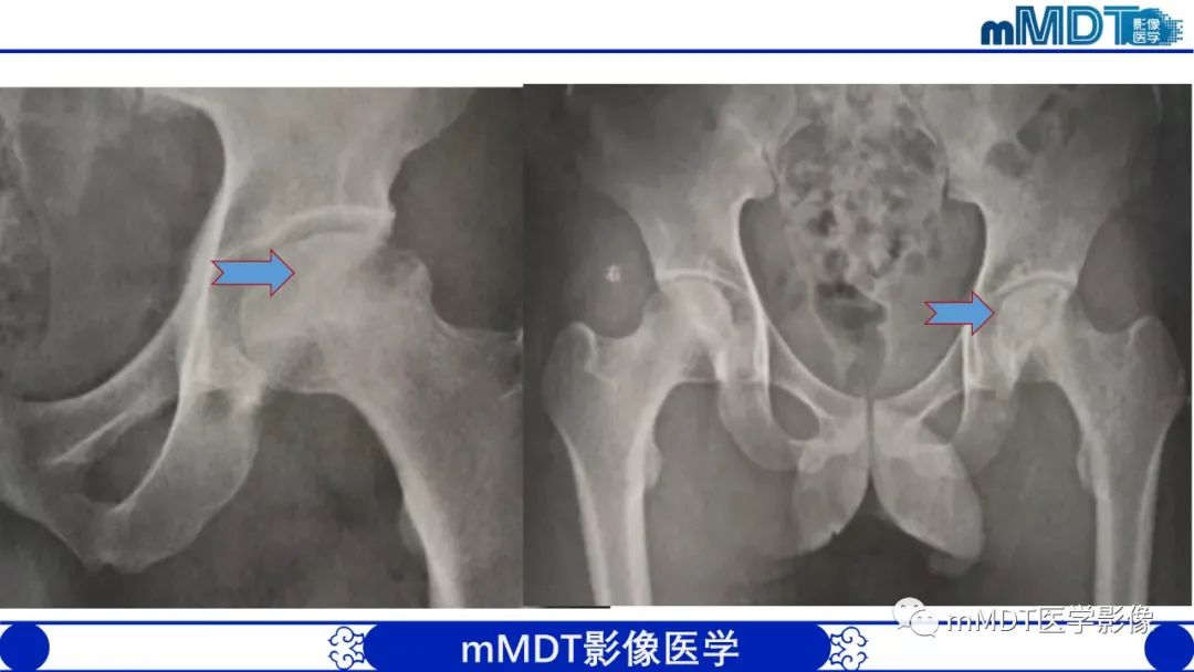 影像PPT - 【PPT】髋关节疼痛临床与影像(一)-28 影像PPT - 【PPT】髋关节疼痛临床与影像(一)-28