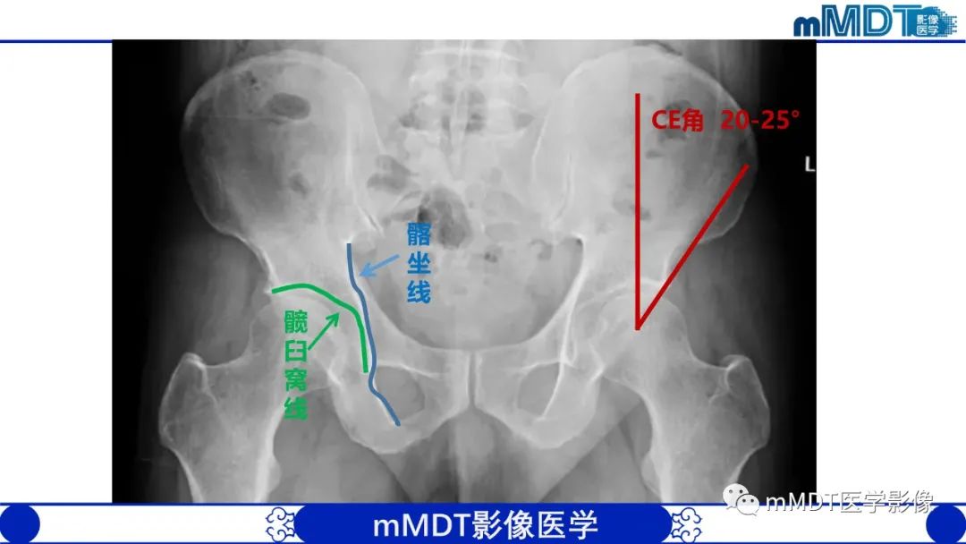 影像PPT - 【PPT】髋关节疼痛临床与影像(一)-15 影像PPT - 【PPT】髋关节疼痛临床与影像(一)-15