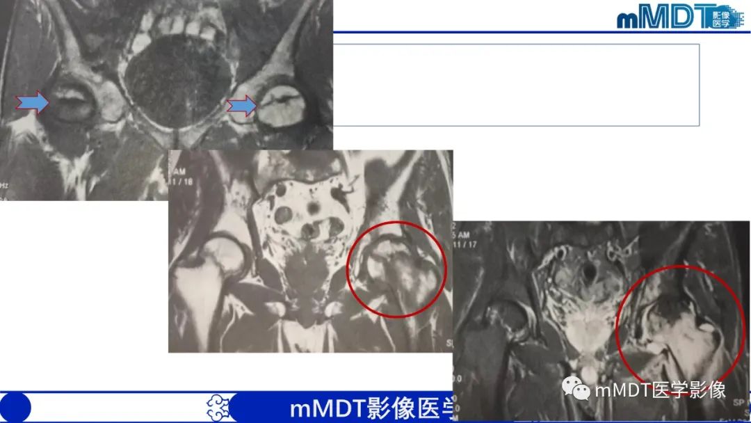 影像PPT - 【PPT】髋关节疼痛临床与影像(一)-30 影像PPT - 【PPT】髋关节疼痛临床与影像(一)-30