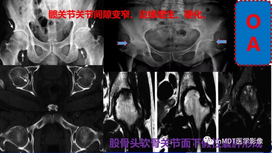 影像PPT - 【PPT】髋关节疼痛临床与影像(一)-32 影像PPT - 【PPT】髋关节疼痛临床与影像(一)-32