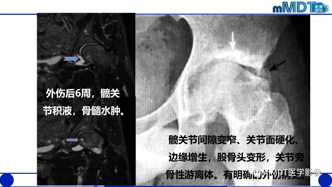 影像PPT - 【PPT】髋关节疼痛临床与影像(一)-37 影像PPT - 【PPT】髋关节疼痛临床与影像(一)-37