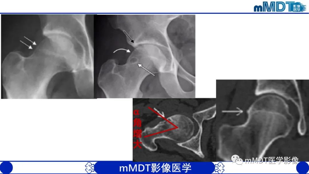 影像PPT - 【PPT】髋关节疼痛临床与影像(一)-19 影像PPT - 【PPT】髋关节疼痛临床与影像(一)-19