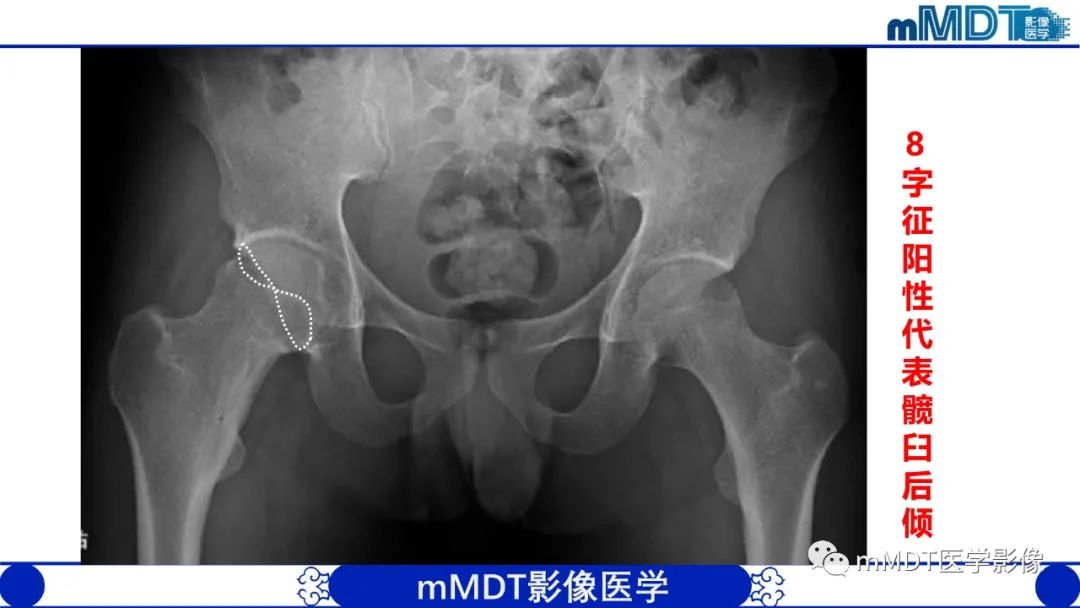 影像PPT - 【PPT】髋关节疼痛临床与影像(一)-23 影像PPT - 【PPT】髋关节疼痛临床与影像(一)-23