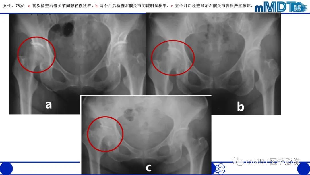 影像PPT - 【PPT】髋关节疼痛临床与影像(一)-34 影像PPT - 【PPT】髋关节疼痛临床与影像(一)-34