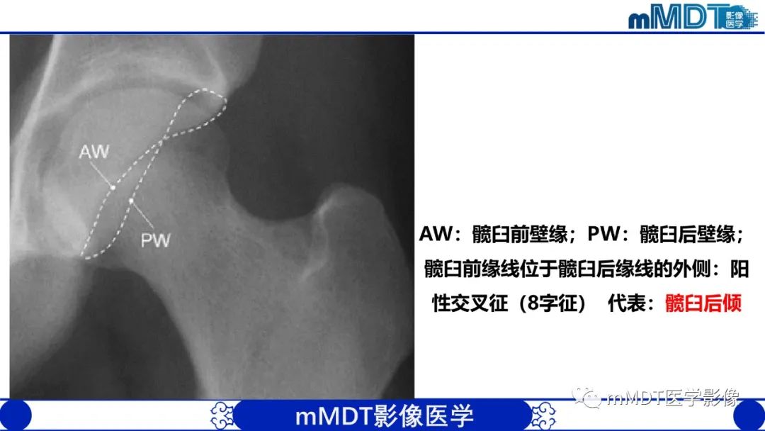 影像PPT - 【PPT】髋关节疼痛临床与影像(一)-22 影像PPT - 【PPT】髋关节疼痛临床与影像(一)-22