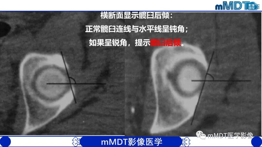 影像PPT - 【PPT】髋关节疼痛临床与影像(一)-25 影像PPT - 【PPT】髋关节疼痛临床与影像(一)-25