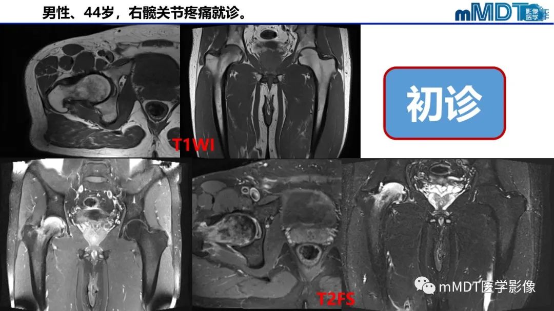 影像PPT - 【PPT】髋关节疼痛临床与影像(一)-5 影像PPT - 【PPT】髋关节疼痛临床与影像(一)-5
