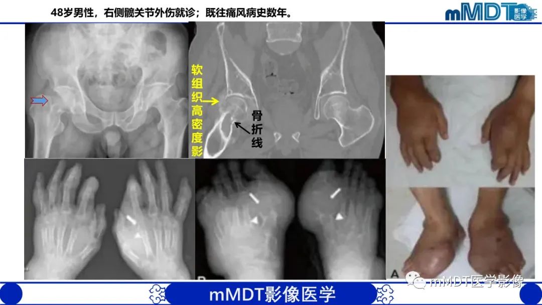 影像PPT - 【PPT】髋关节疼痛临床与影像(一)-49 影像PPT - 【PPT】髋关节疼痛临床与影像(一)-49