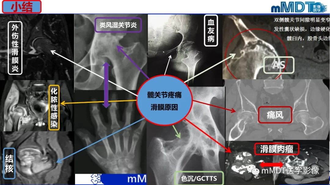 影像PPT - 【PPT】髋关节疼痛临床与影像(一)-58 影像PPT - 【PPT】髋关节疼痛临床与影像(一)-58