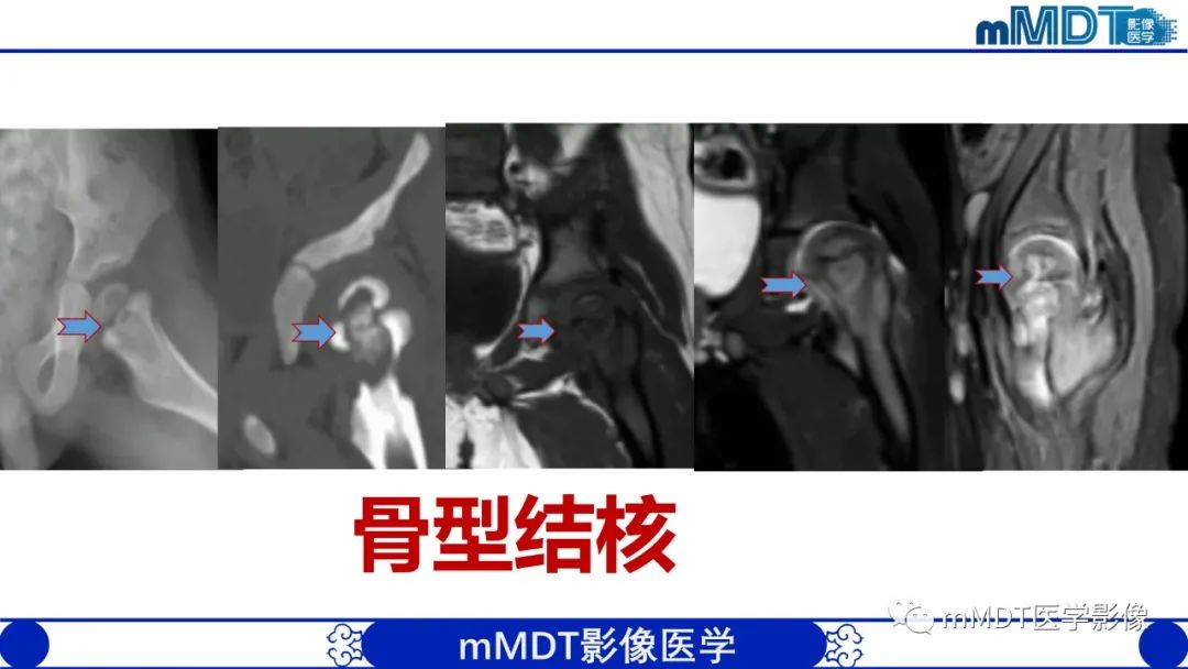 影像PPT - 【PPT】髋关节疼痛临床与影像(一)-43 影像PPT - 【PPT】髋关节疼痛临床与影像(一)-43