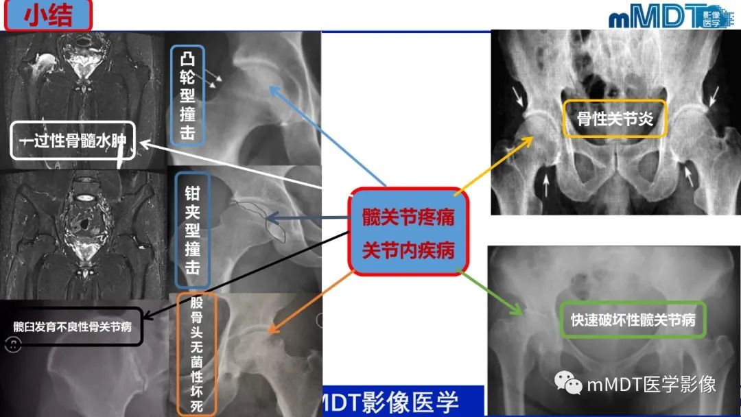 影像PPT - 【PPT】髋关节疼痛临床与影像(一)-57 影像PPT - 【PPT】髋关节疼痛临床与影像(一)-57