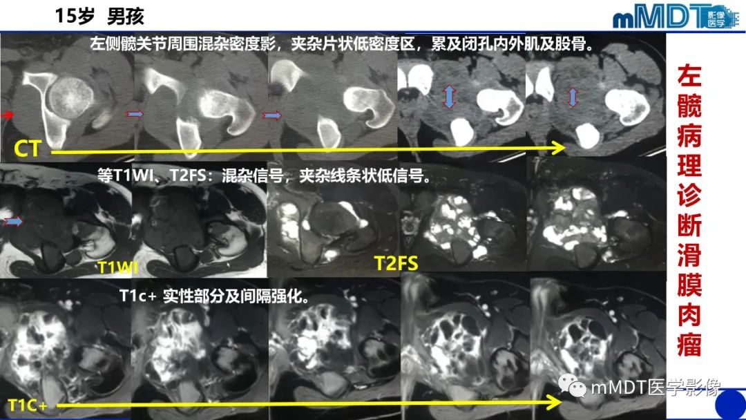 影像PPT - 【PPT】髋关节疼痛临床与影像(一)-56 影像PPT - 【PPT】髋关节疼痛临床与影像(一)-56