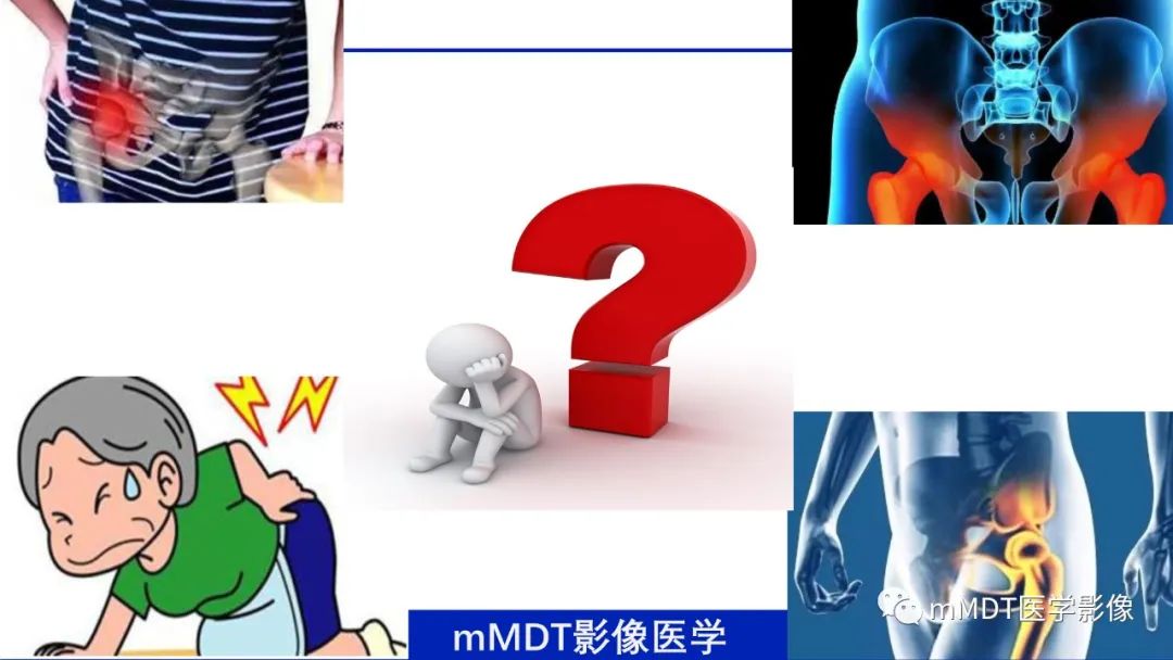 影像PPT - 【PPT】髋关节疼痛临床与影像(一)-2 影像PPT - 【PPT】髋关节疼痛临床与影像(一)-2