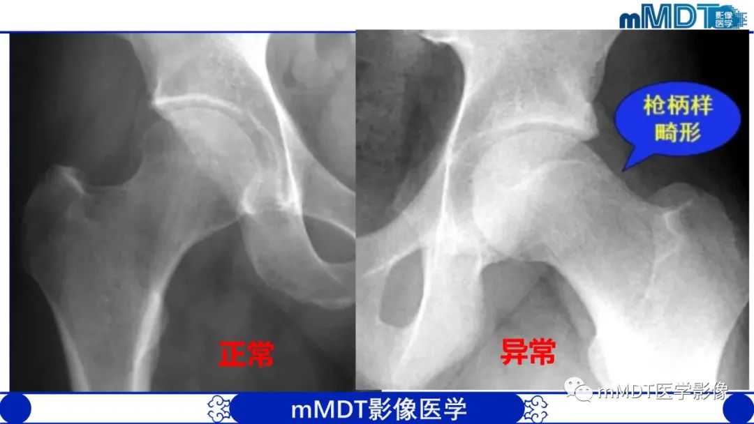 影像PPT - 【PPT】髋关节疼痛临床与影像(一)-18 影像PPT - 【PPT】髋关节疼痛临床与影像(一)-18