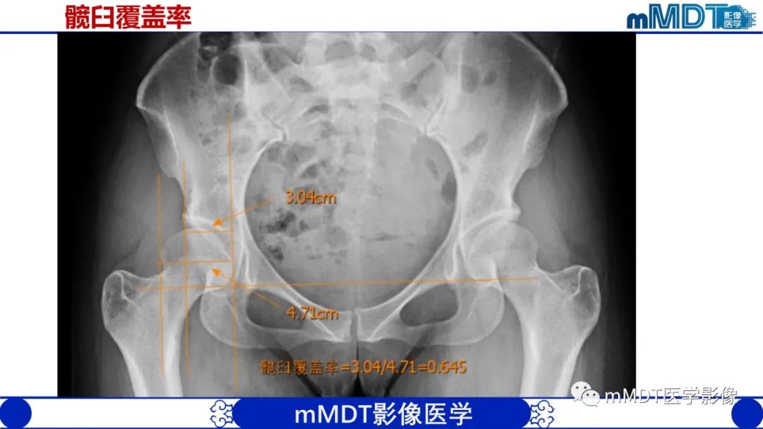 影像PPT - 【PPT】髋关节疼痛临床与影像(一)-11 影像PPT - 【PPT】髋关节疼痛临床与影像(一)-11