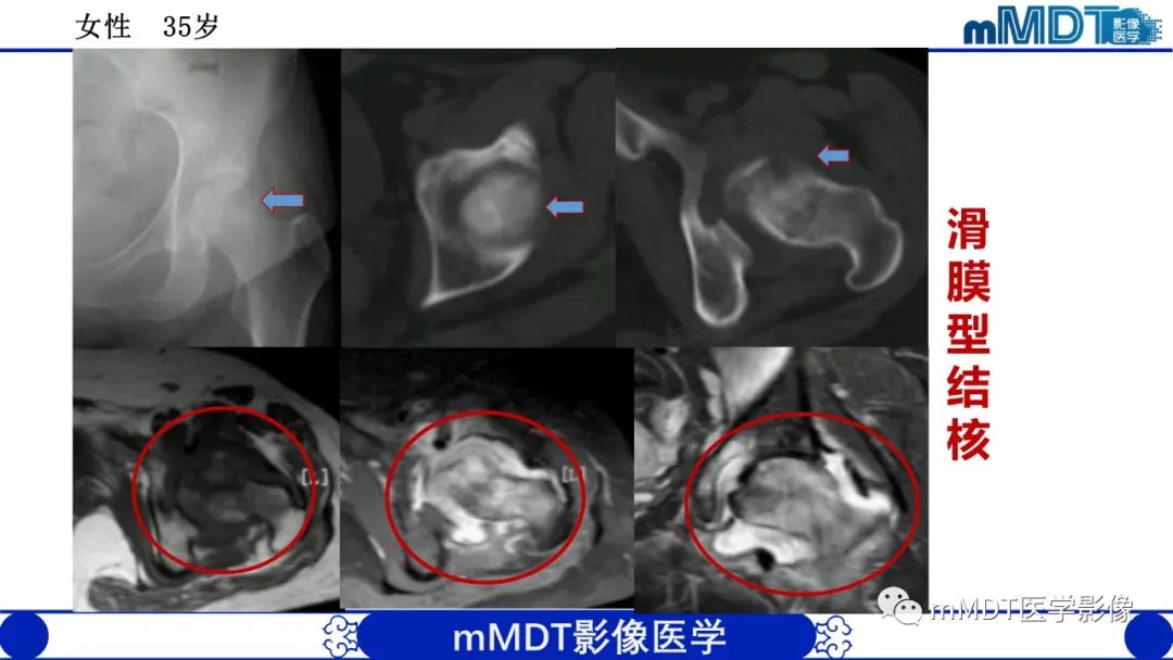 影像PPT - 【PPT】髋关节疼痛临床与影像(一)-42 影像PPT - 【PPT】髋关节疼痛临床与影像(一)-42