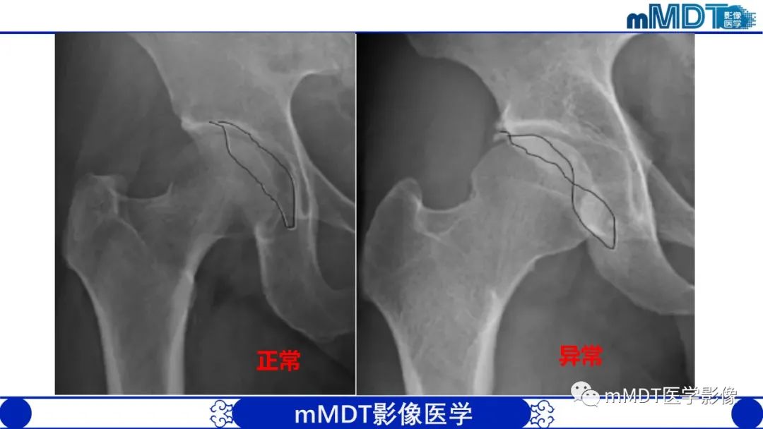 影像PPT - 【PPT】髋关节疼痛临床与影像(一)-24 影像PPT - 【PPT】髋关节疼痛临床与影像(一)-24