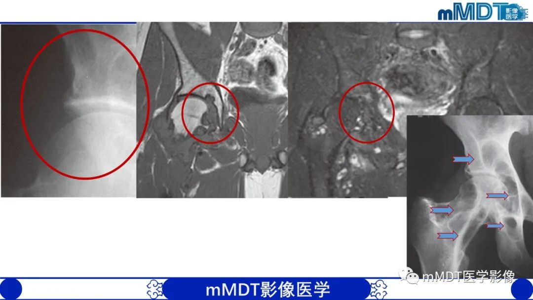 影像PPT - 【PPT】髋关节疼痛临床与影像(一)-53 影像PPT - 【PPT】髋关节疼痛临床与影像(一)-53