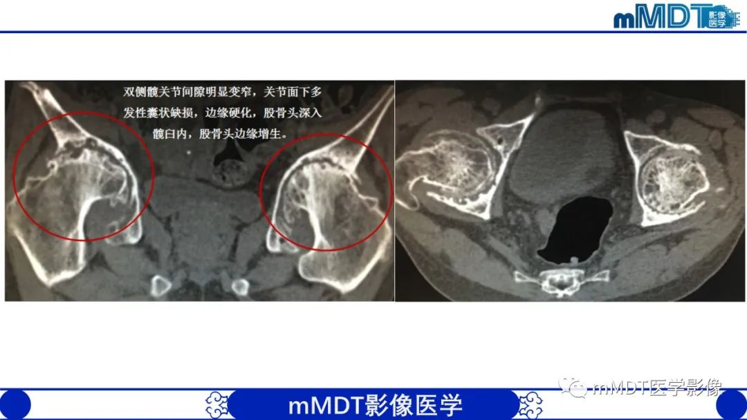 影像PPT - 【PPT】髋关节疼痛临床与影像(一)-47 影像PPT - 【PPT】髋关节疼痛临床与影像(一)-47