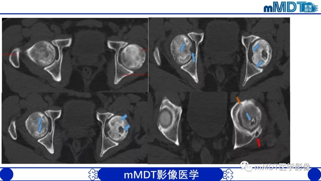 影像PPT - 【PPT】髋关节疼痛临床与影像(一)-29 影像PPT - 【PPT】髋关节疼痛临床与影像(一)-29