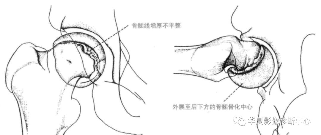 影像PPT - 股骨头骨骺滑脱-1 影像PPT - 股骨头骨骺滑脱-1