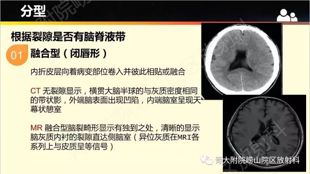 影像PPT - 【PPT】脑裂畸形-6