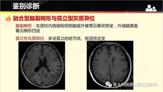 影像PPT - 【PPT】脑裂畸形-9