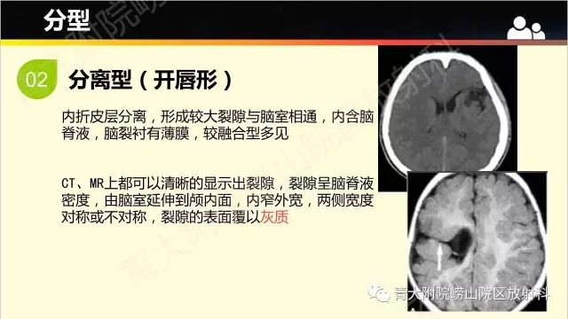 影像PPT - 【PPT】脑裂畸形-7
