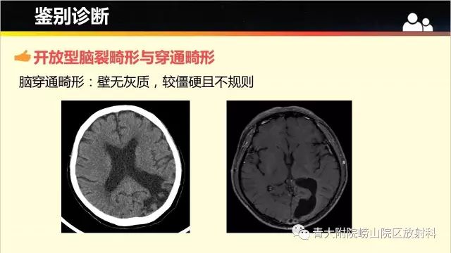 影像PPT - 【PPT】脑裂畸形-8