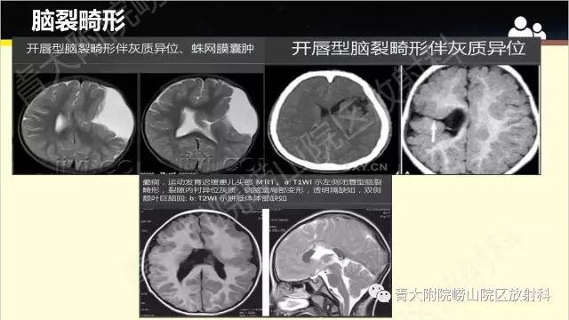 影像PPT - 【PPT】脑裂畸形-5