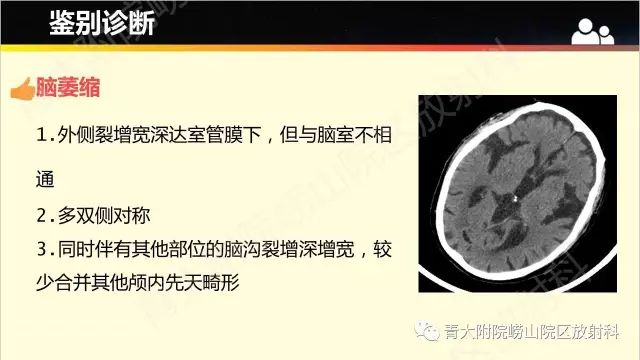 影像PPT - 【PPT】脑裂畸形-10