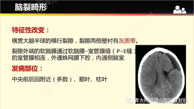影像PPT - 【PPT】脑裂畸形-3
