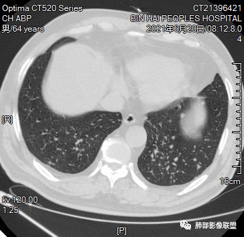 影像PPT - 【病例】一例黑色素瘤术后点晕状肺转移变化并文献学习-23 影像PPT - 【病例】一例黑色素瘤术后点晕状肺转移变化并文献学习-23