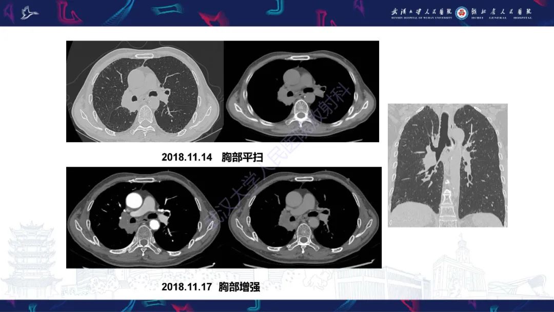 影像PPT - 【PPT】肺癌术后并发症影像诊断-3