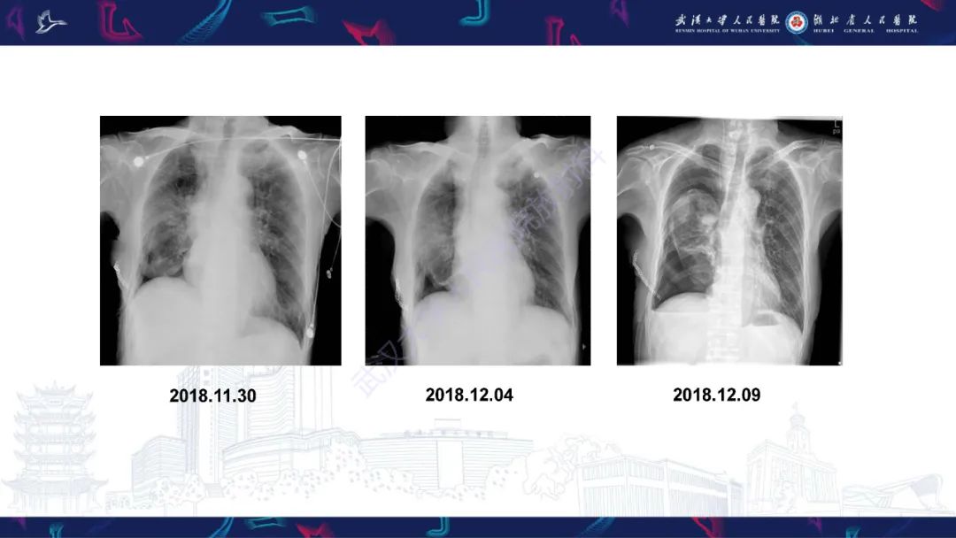 影像PPT - 【PPT】肺癌术后并发症影像诊断-6
