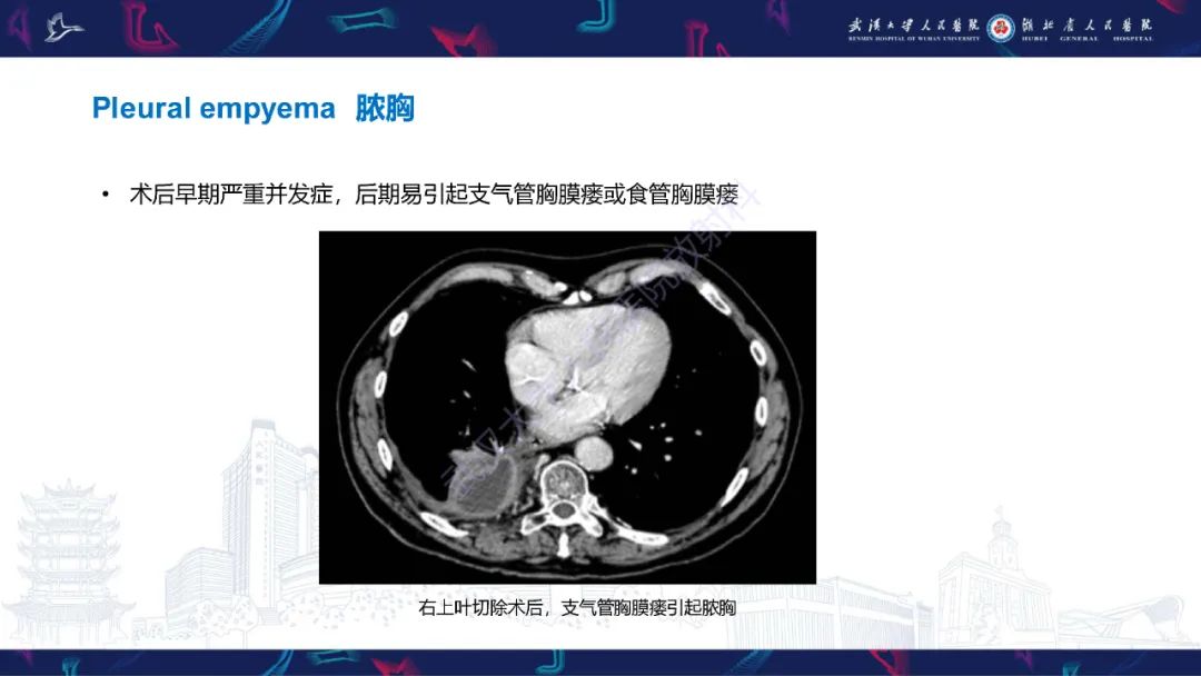 影像PPT - 【PPT】肺癌术后并发症影像诊断-28