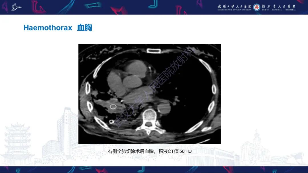 影像PPT - 【PPT】肺癌术后并发症影像诊断-29