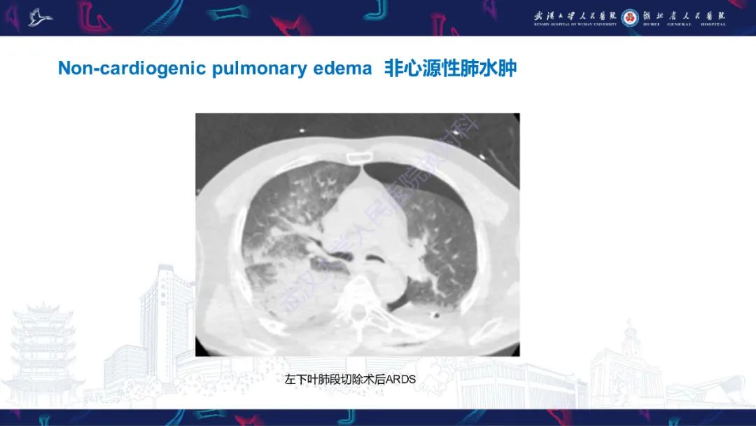 影像PPT - 【PPT】肺癌术后并发症影像诊断-33
