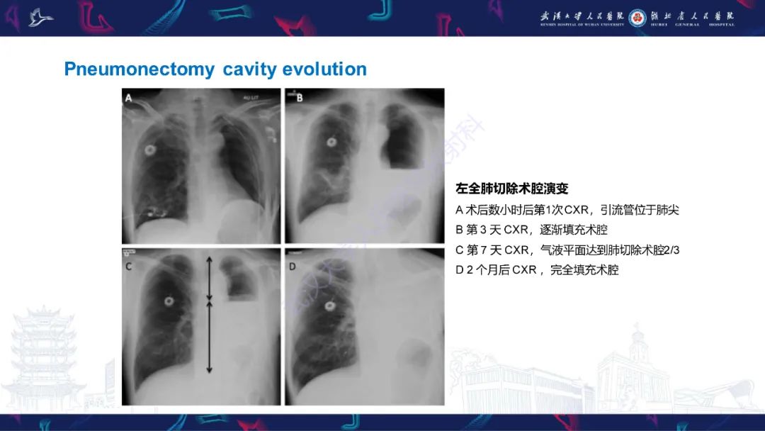 影像PPT - 【PPT】肺癌术后并发症影像诊断-22