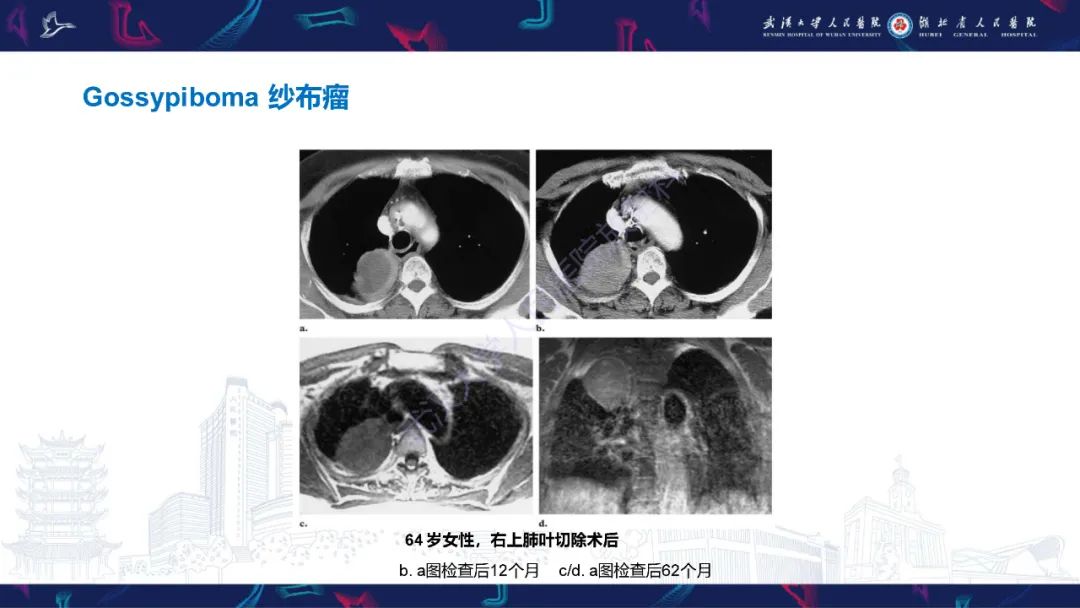 影像PPT - 【PPT】肺癌术后并发症影像诊断-43