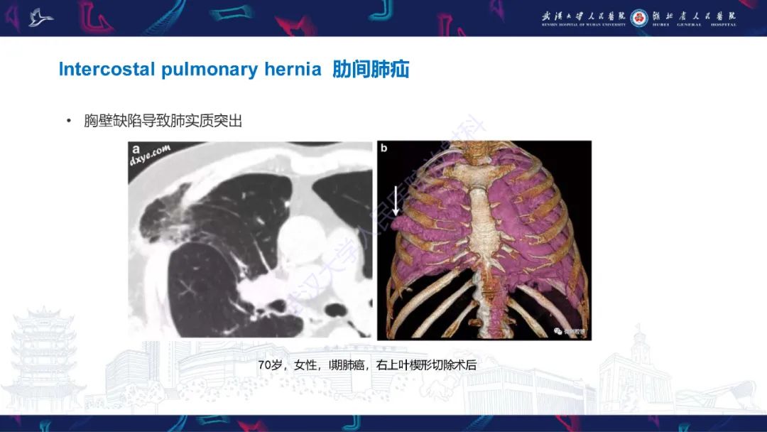 影像PPT - 【PPT】肺癌术后并发症影像诊断-42
