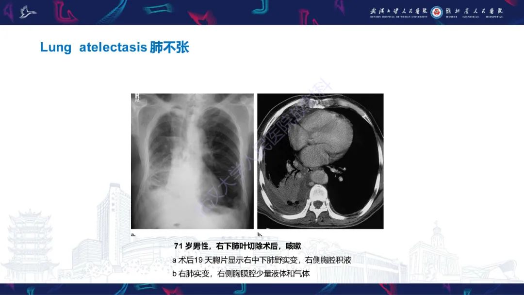 影像PPT - 【PPT】肺癌术后并发症影像诊断-30