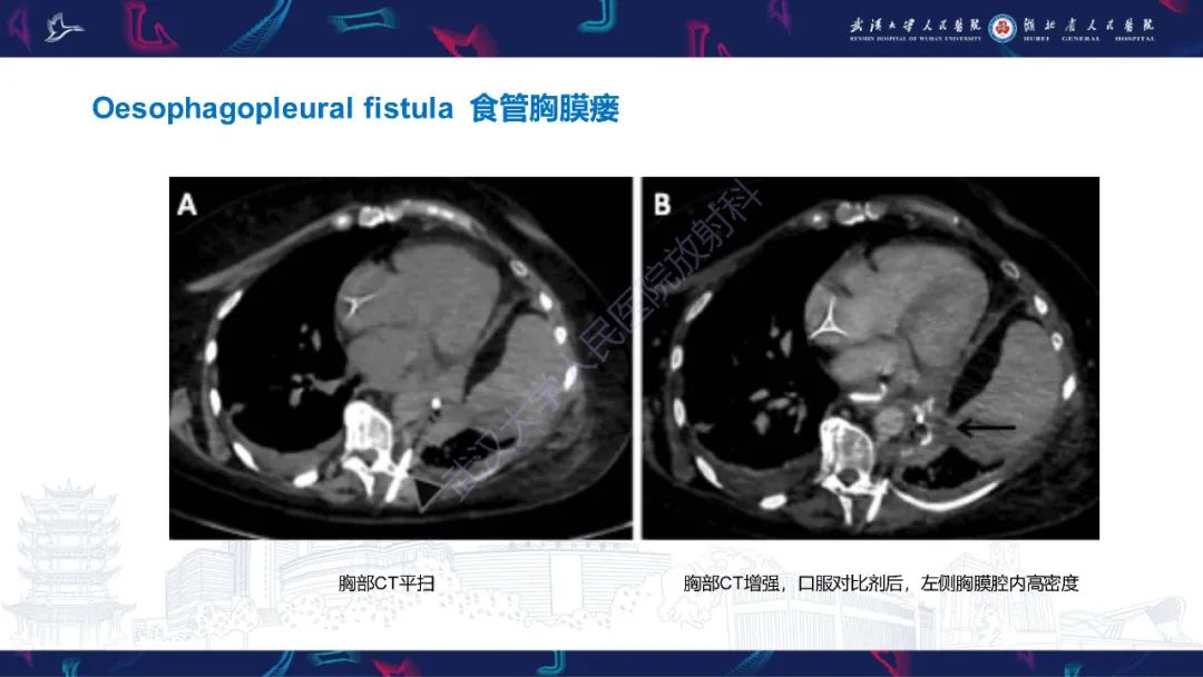 影像PPT - 【PPT】肺癌术后并发症影像诊断-36