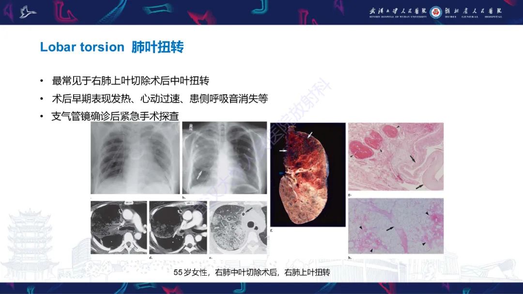 影像PPT - 【PPT】肺癌术后并发症影像诊断-34