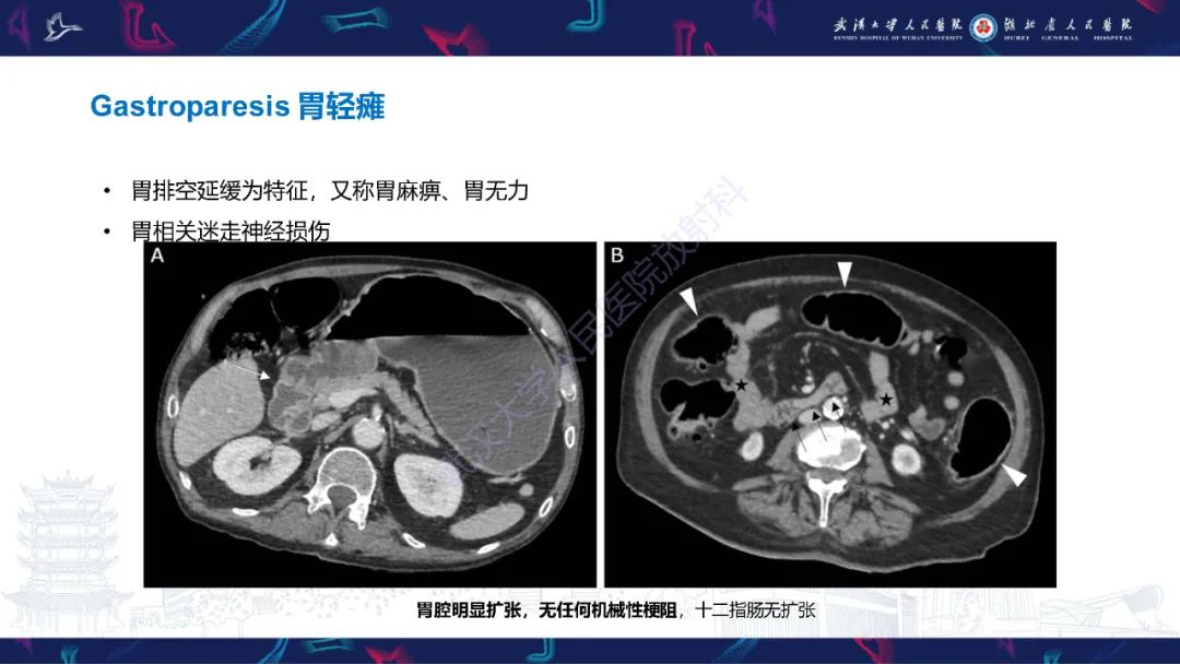 影像PPT - 【PPT】肺癌术后并发症影像诊断-39