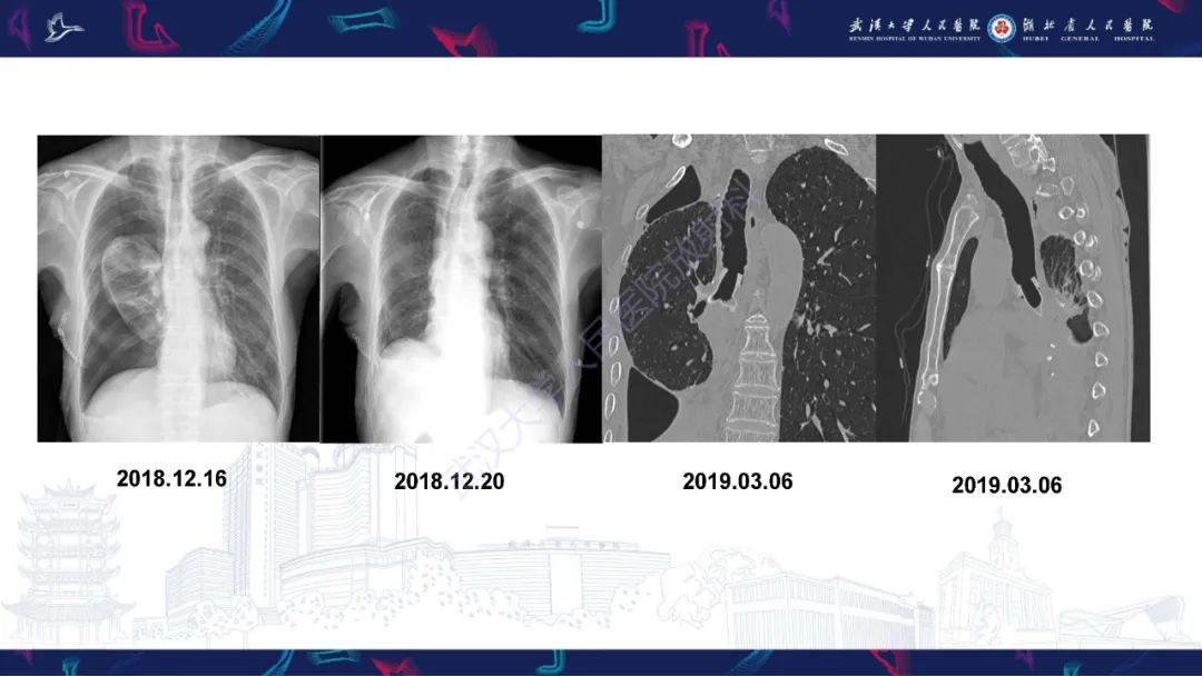 影像PPT - 【PPT】肺癌术后并发症影像诊断-9